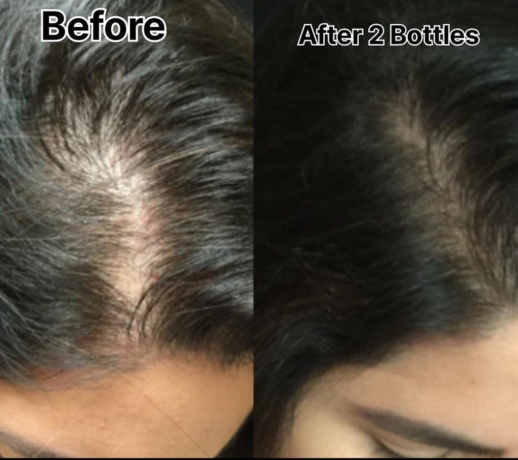 Onion Shampoo + Hair Oil - Combo Pack for Hair Care